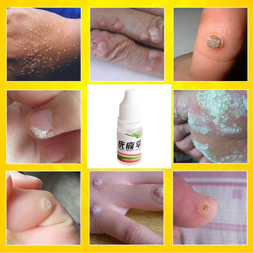 body-warts-treatment-asghedom